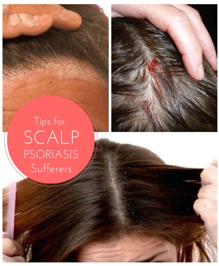 How To Get Rid Of Psoriasis Buildup On Scalp At Gene Courtney Blog