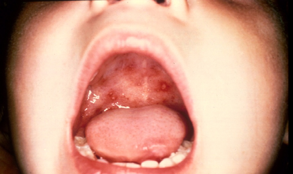 Hand foot and mouth disease adult symptoms